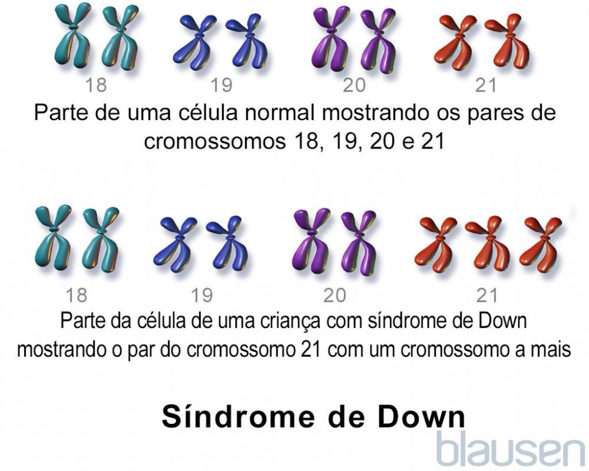 Síndrome de Down: Trissomia 21