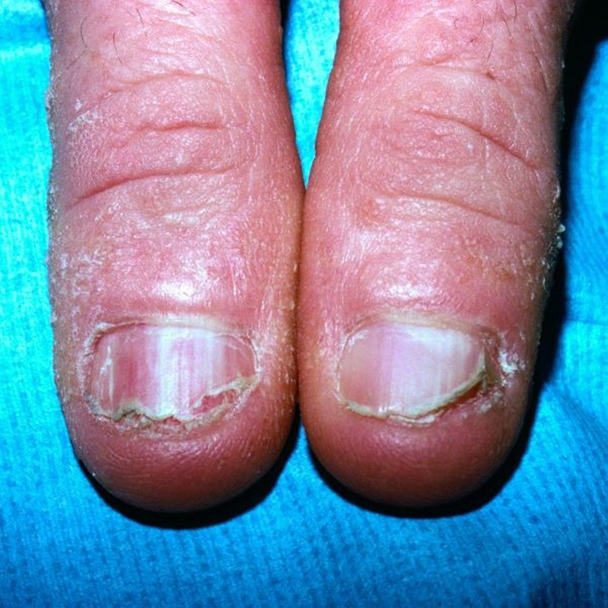 Ugonjwa wa Darier (Kucha)