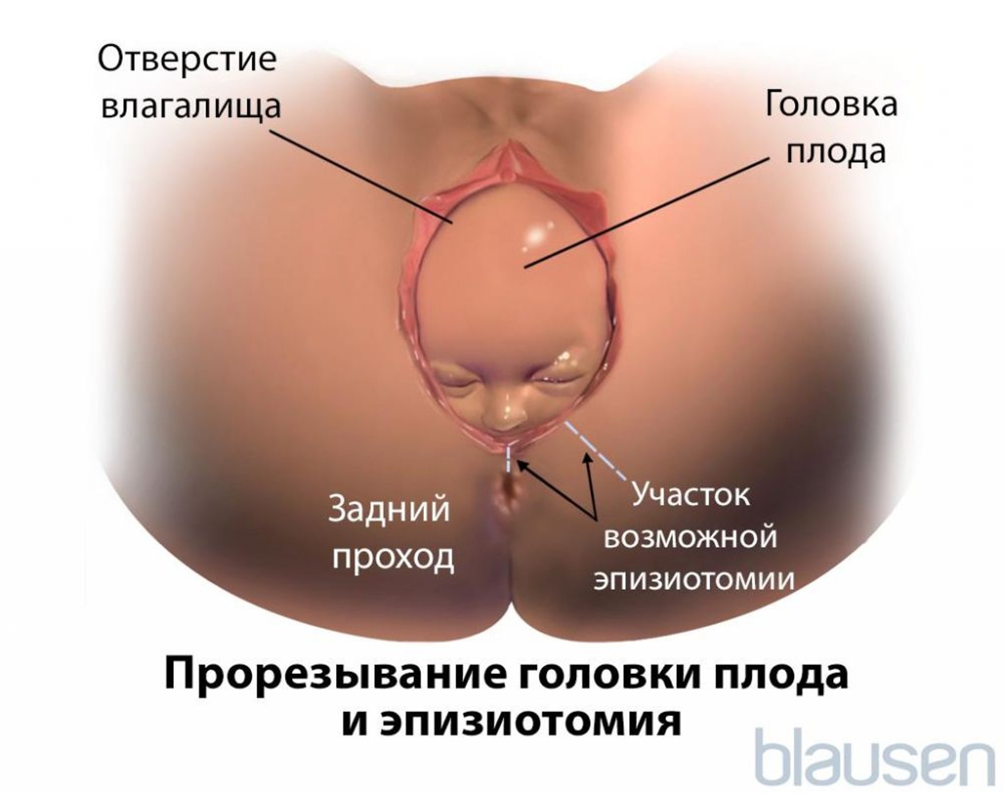 Прорезывание головки плода во время рождения