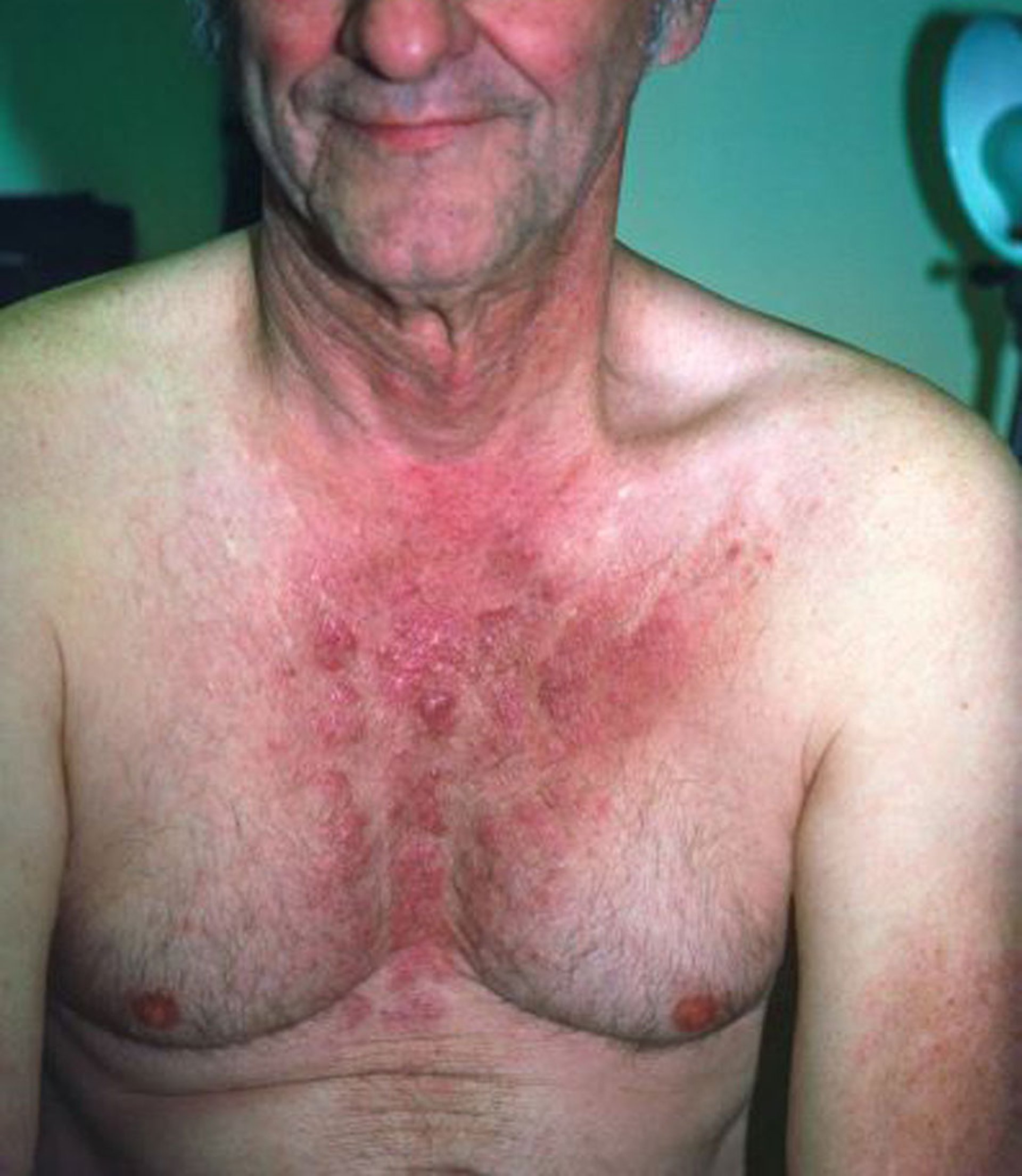 Dermatomiositis (signo V)