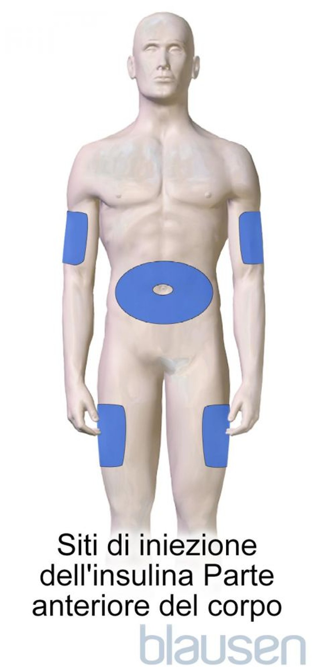 Siti di iniezione dell’insulina (parte anteriore del corpo)