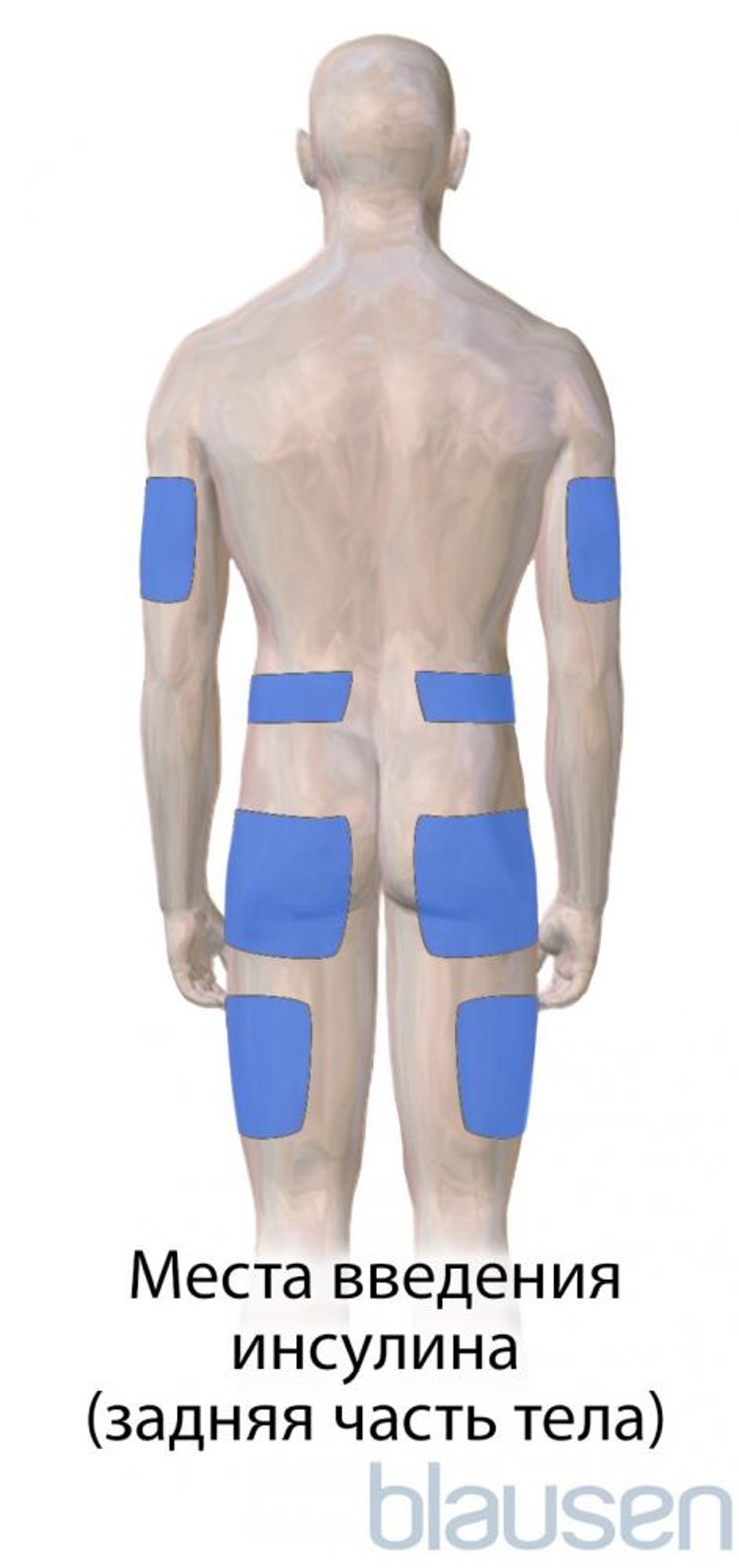 Диабет Места введения инсулина (задняя часть тела)