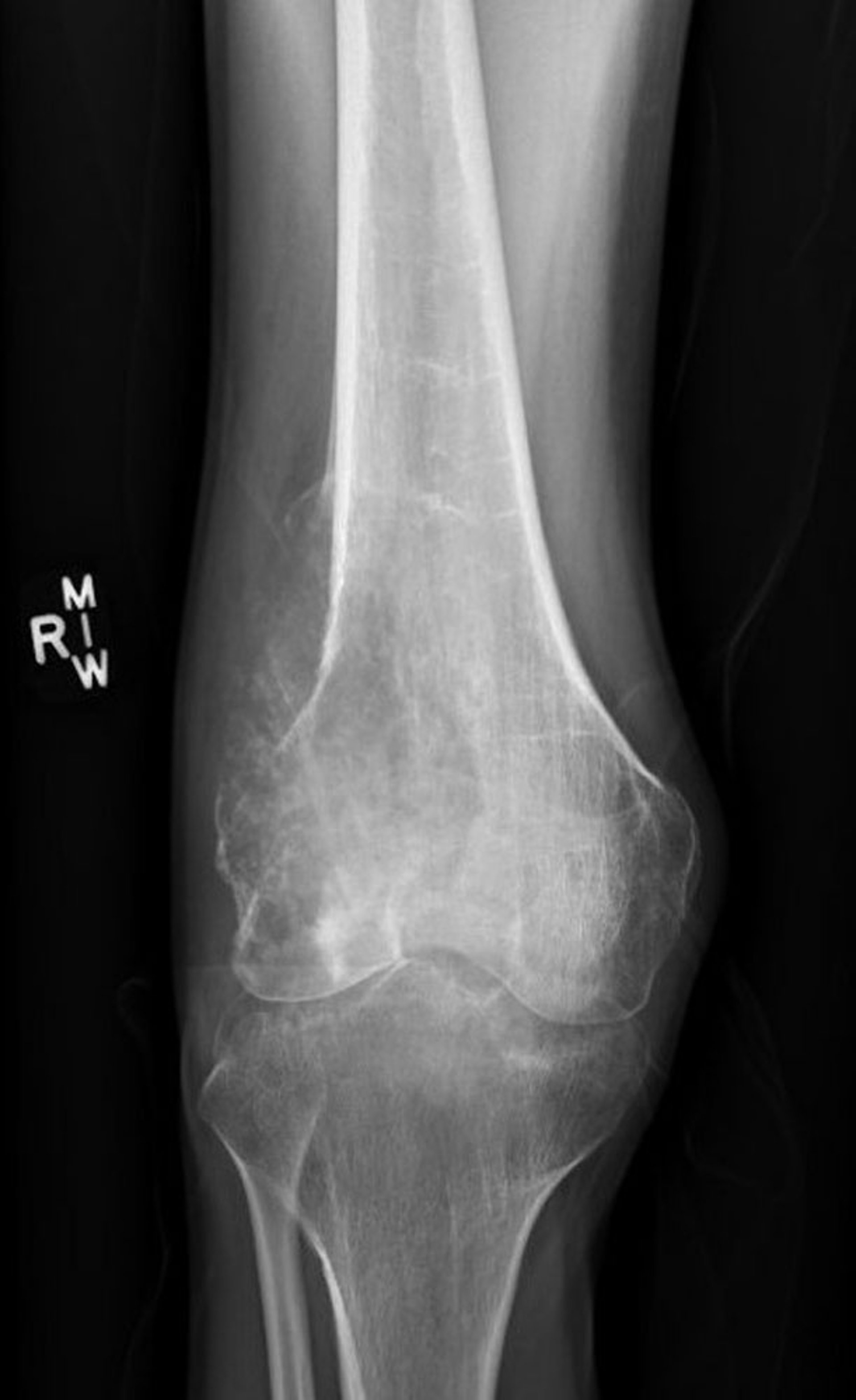 Osteosarcoma