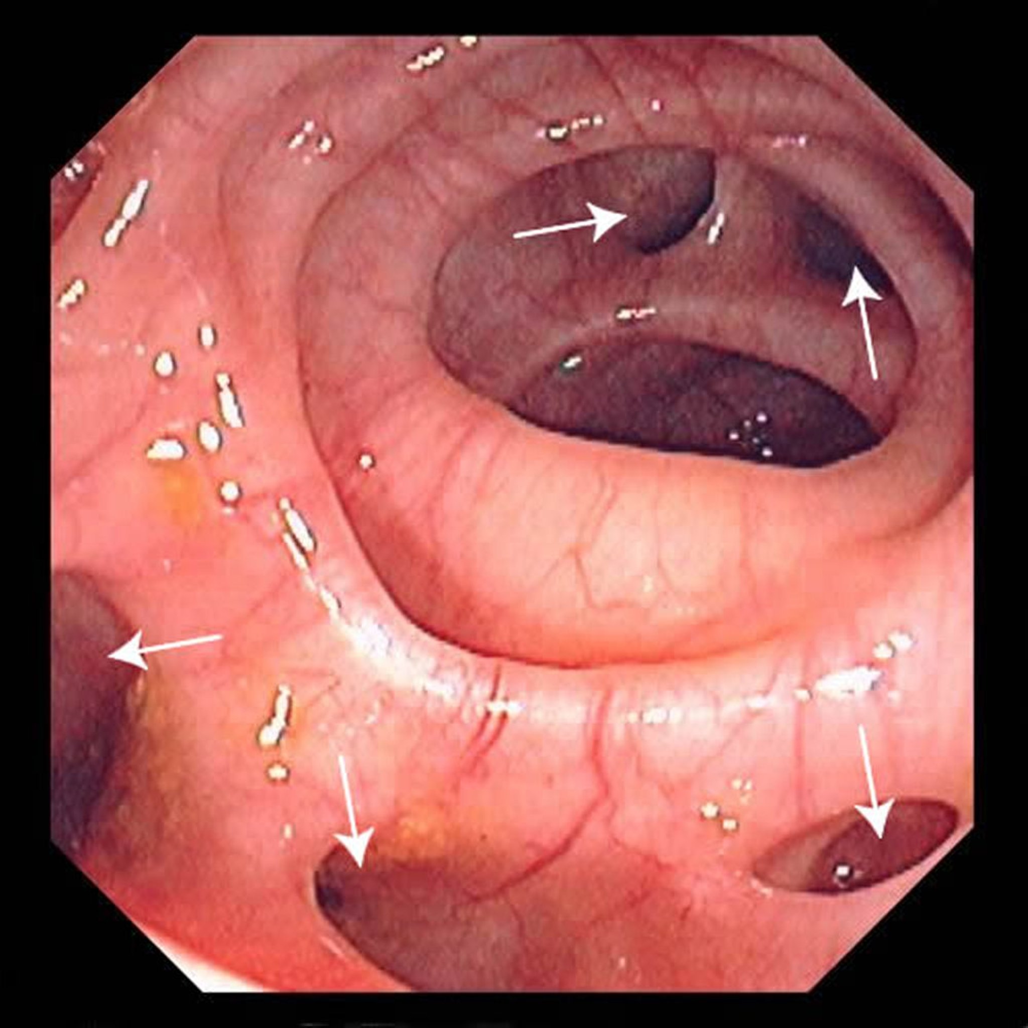 Diverticolosi