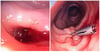 Diverticulum With Bleeding