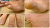 Dyshidrotic Dermatitis