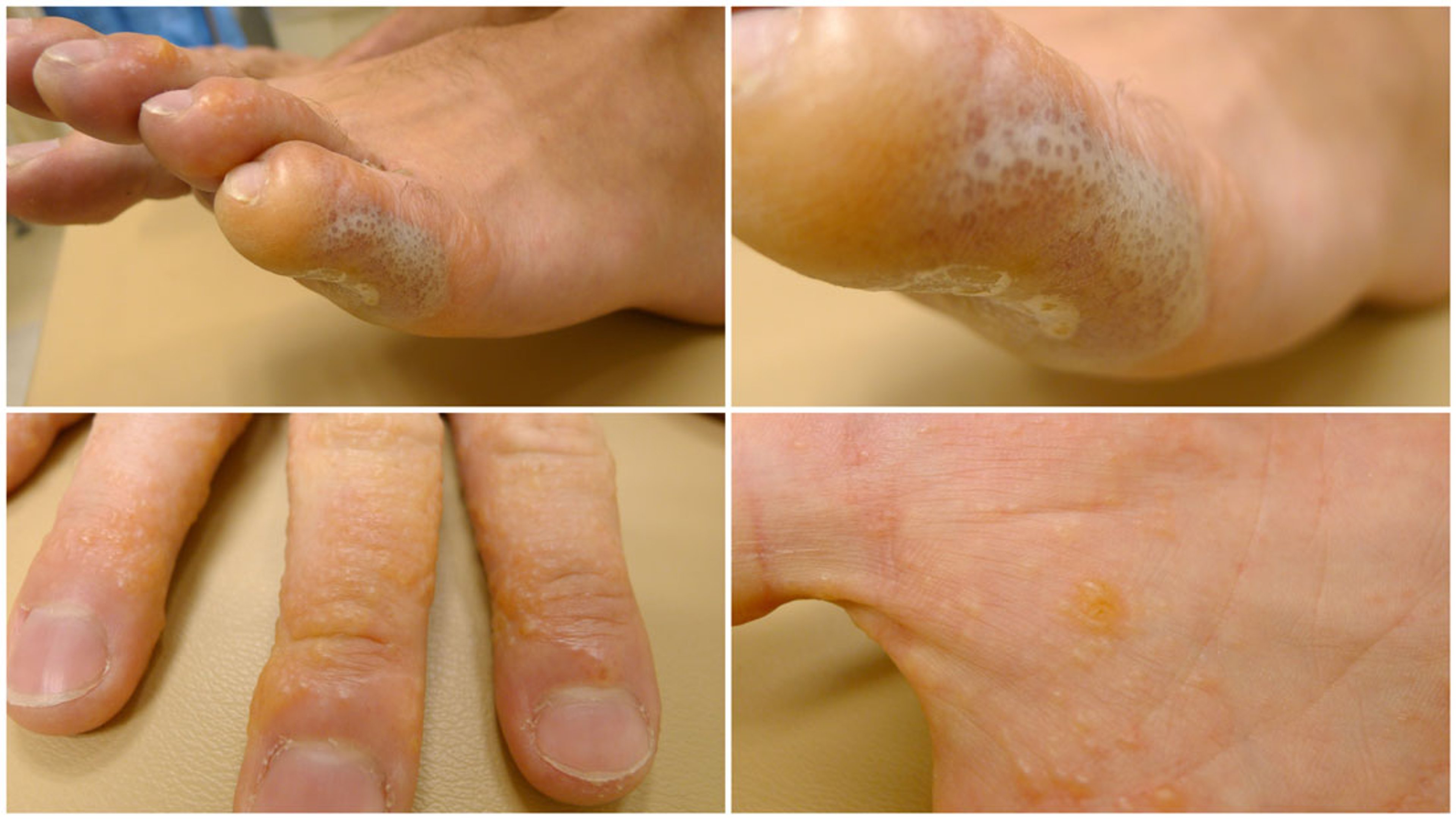 Dermatitis dishidrótica