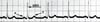 ECG: Normal Heartbeat