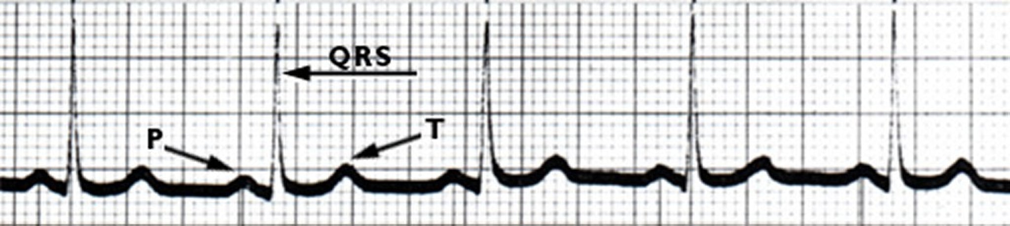 ECG: Normal Heartbeat
