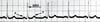 ECG: ritmo cardíaco normal