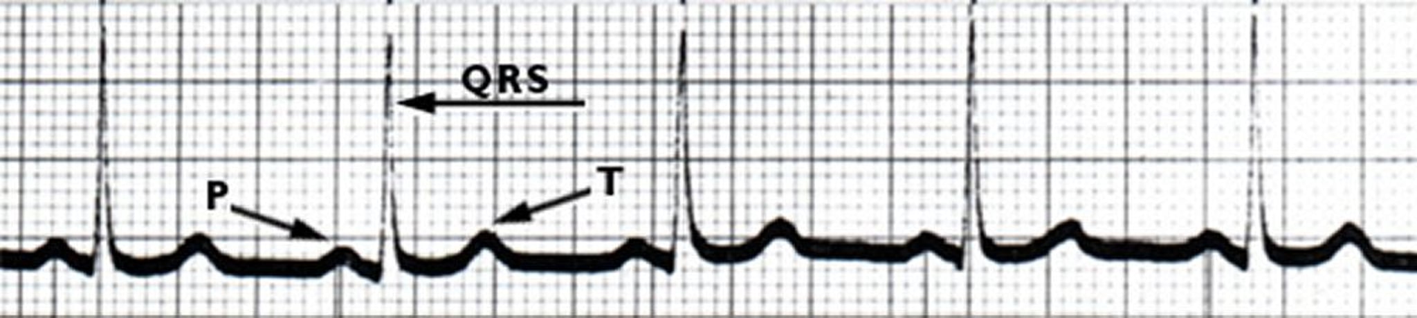 ECG: 정상적인 심장 박동
