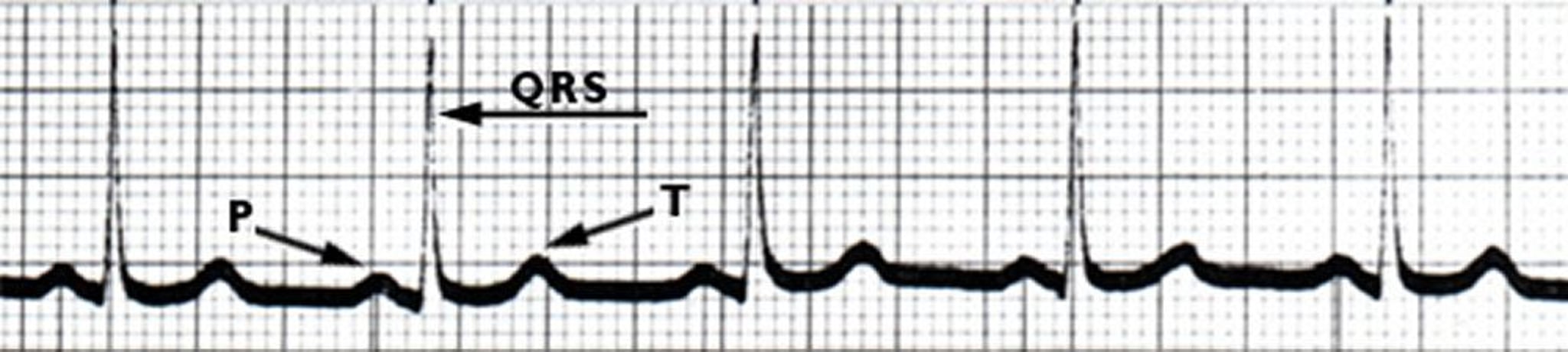 ECG: Batimentos cardíacos normais