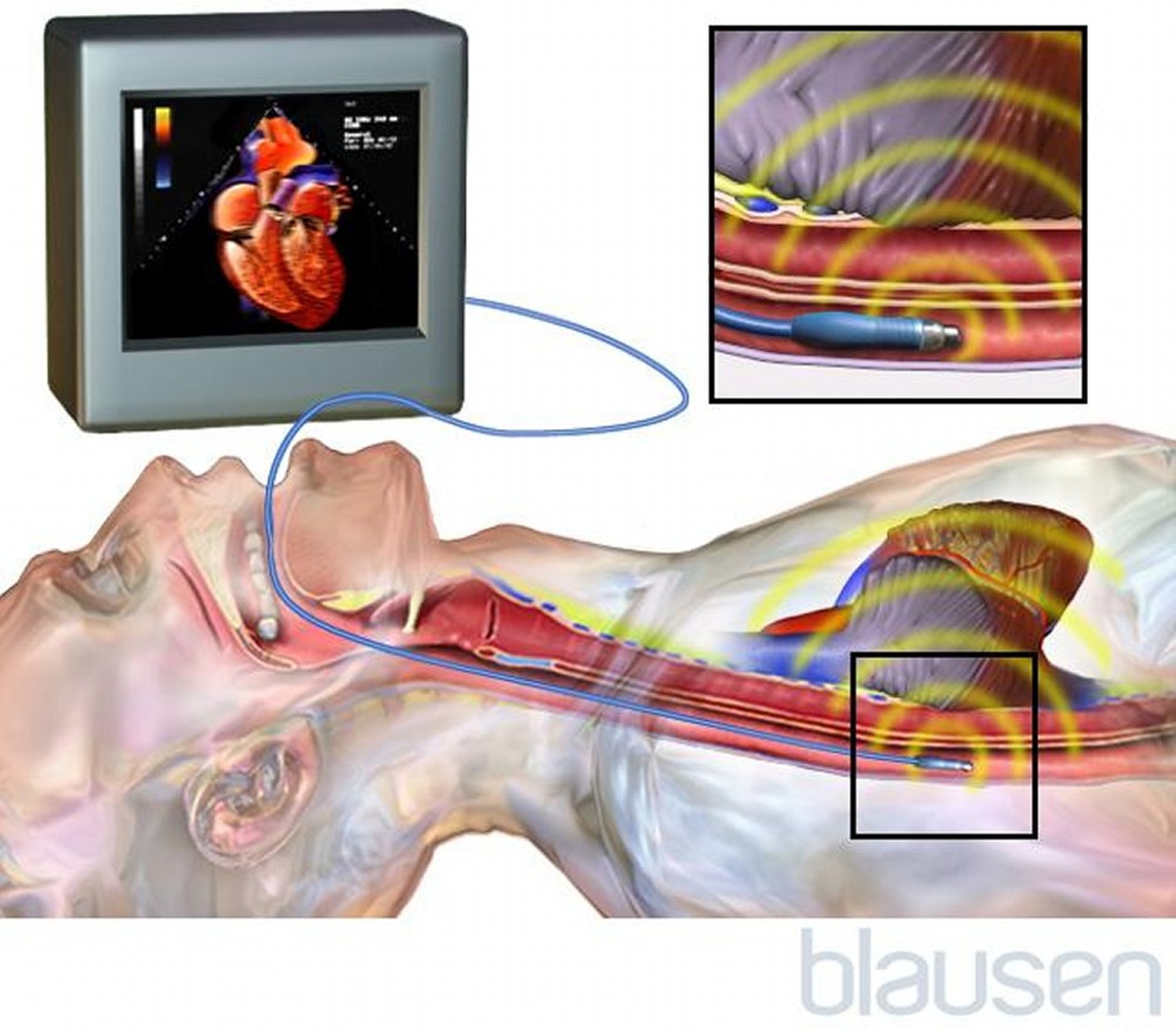 Transesophageal Echocardiogram