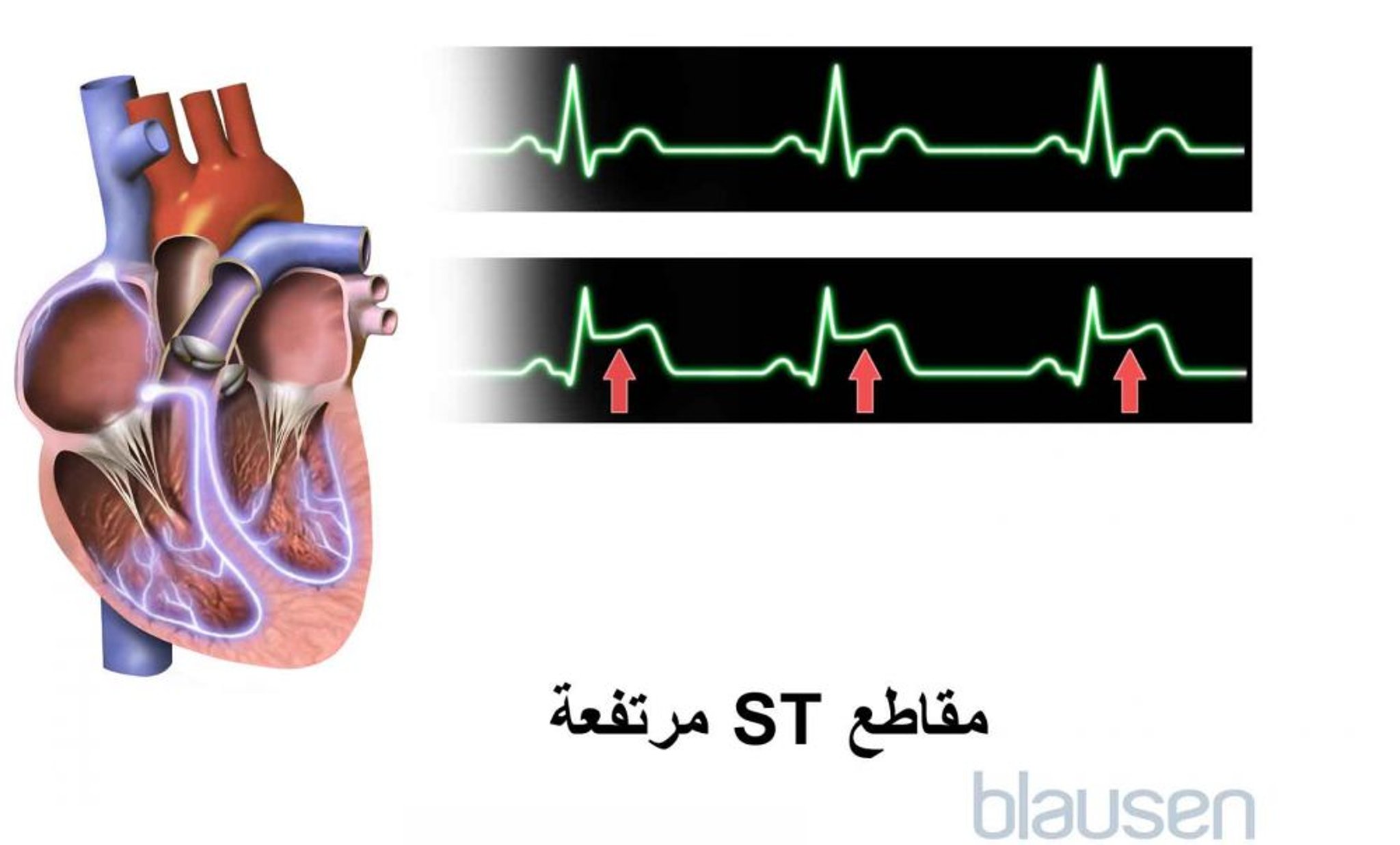 قطع-ST المرتفعة