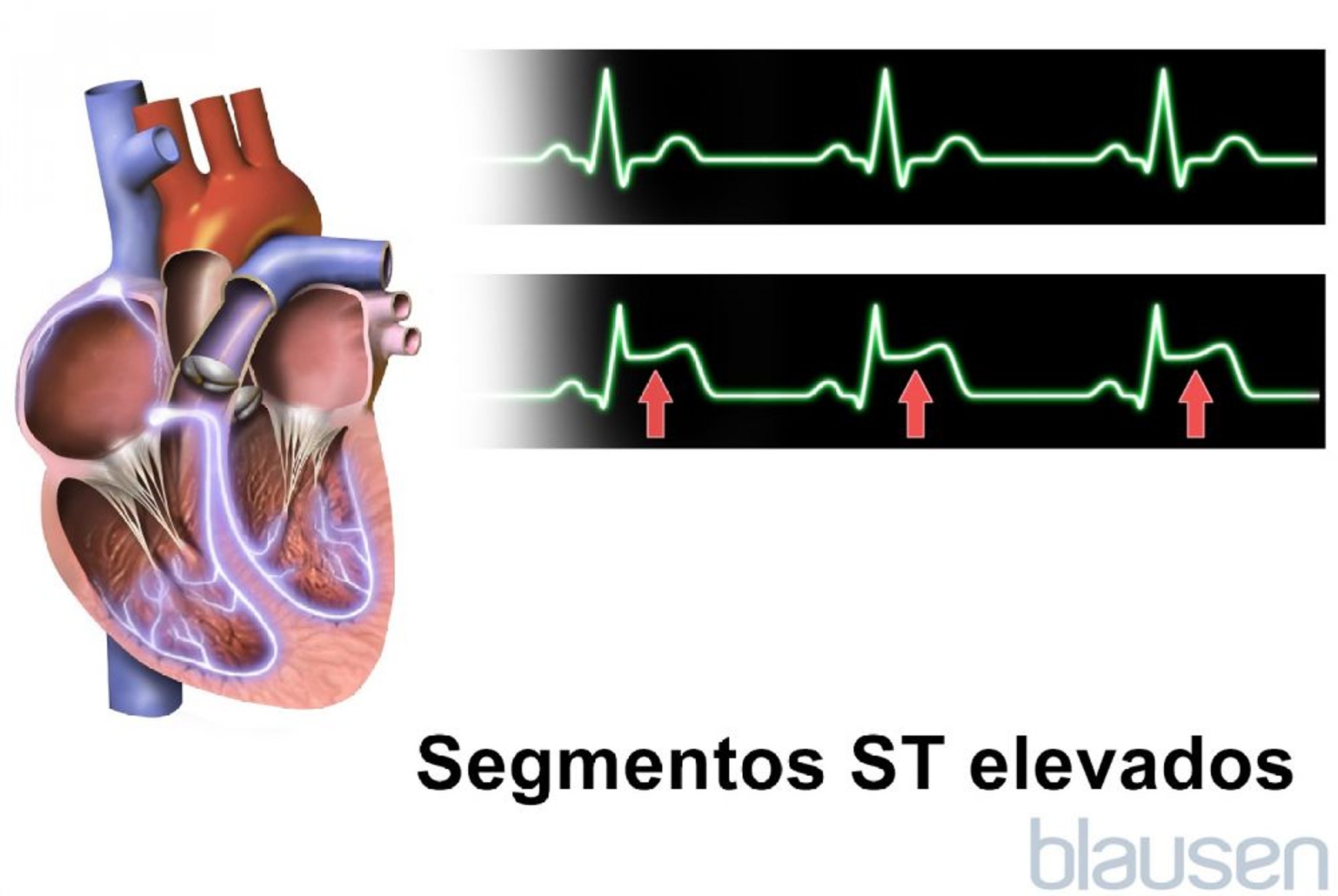 Segmentos ST elevados