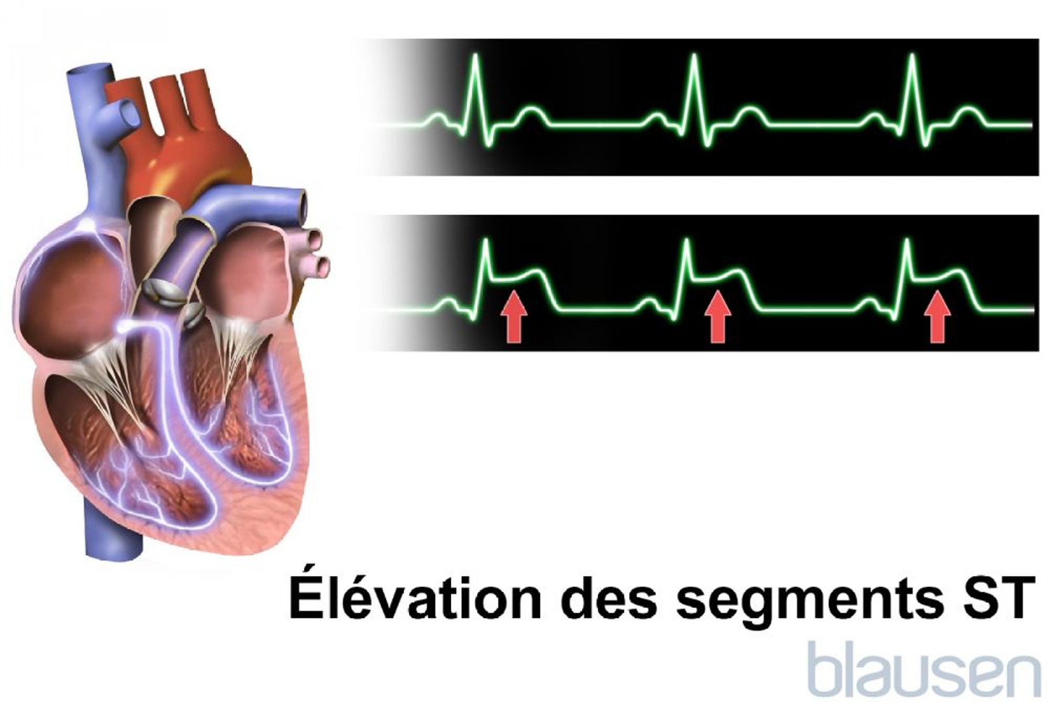 Surélévation des segments ST