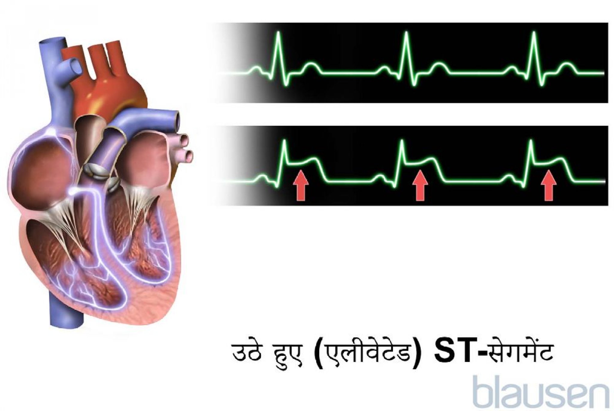 उठे हुए (एलीवेटेड) ST-सेगमेंट