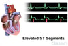 ST 분절 상승