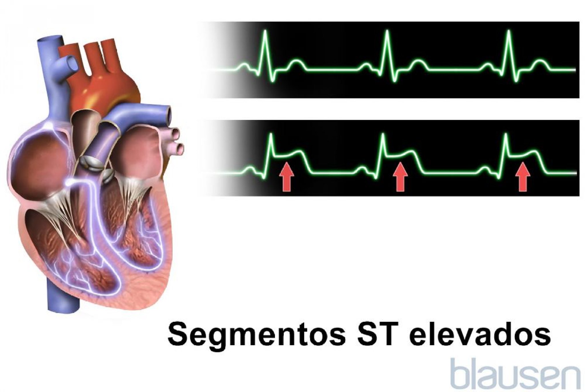 Segmentos ST elevados