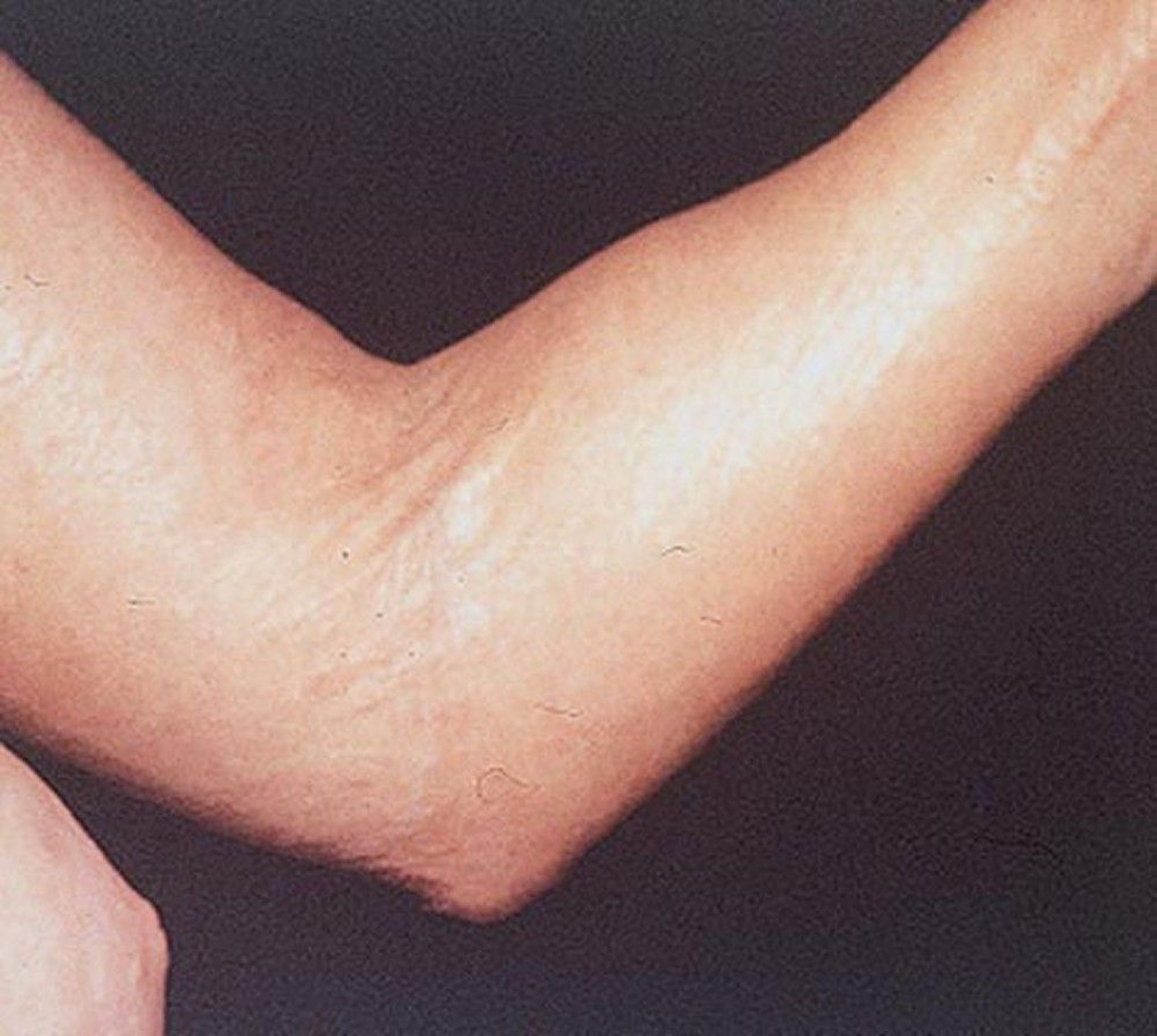 Elbow Contracture in Systemic Sclerosis