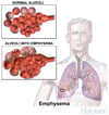 Emphysema