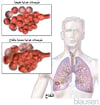النُفاخ الرئوي Emphysema
