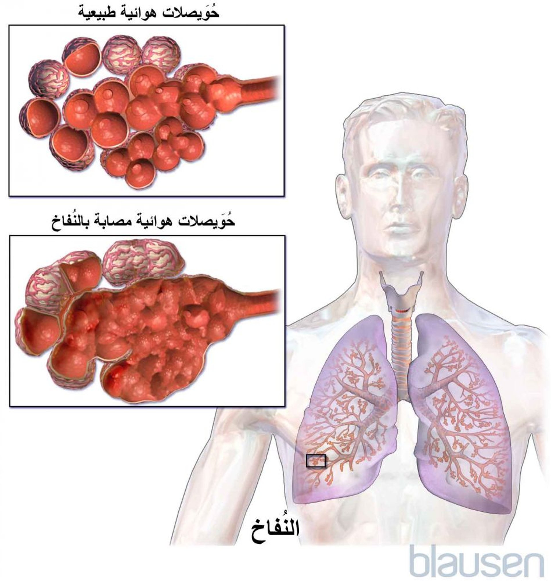 النُفاخ الرئوي Emphysema