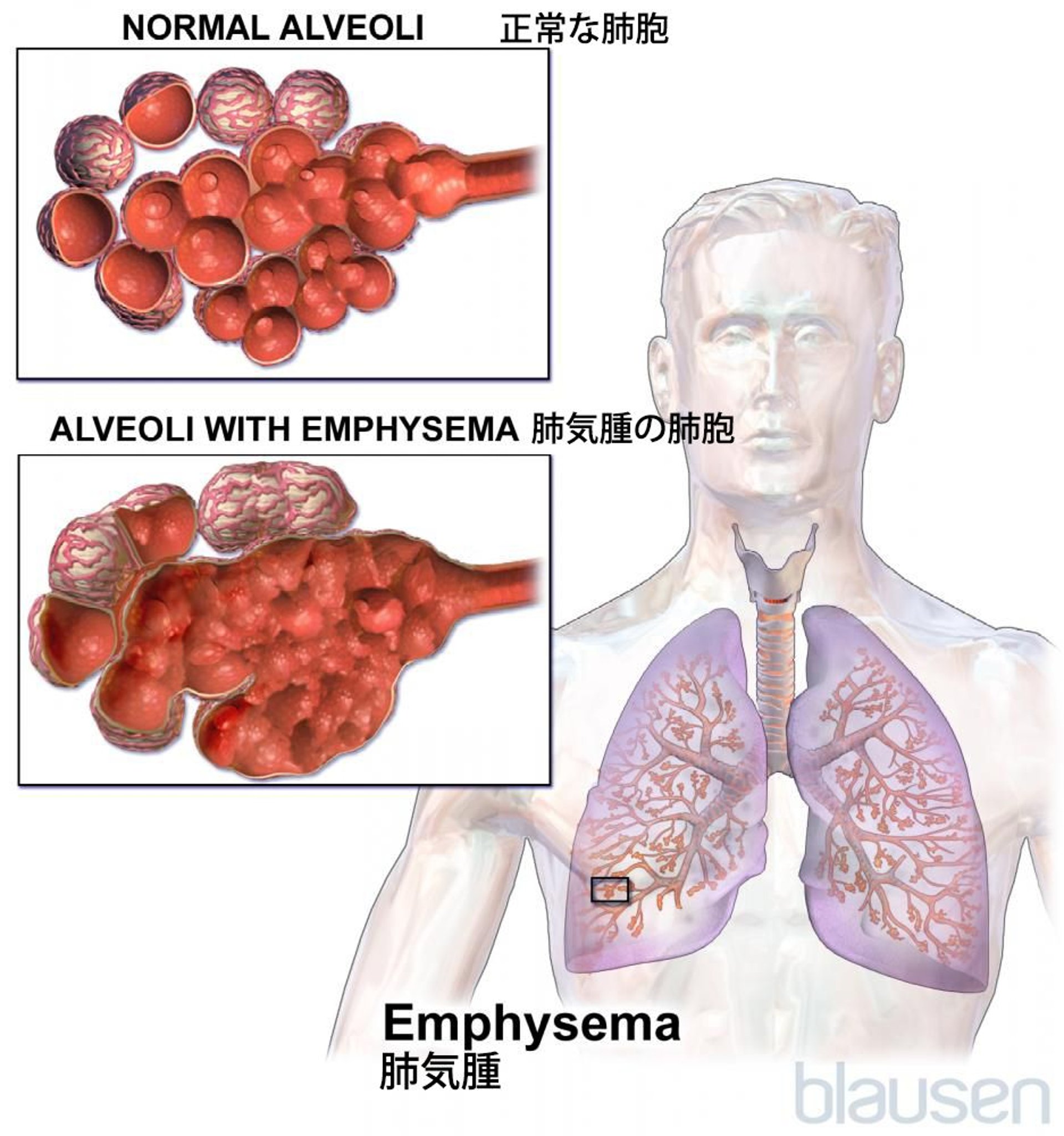 <ruby >肺気腫<rt >はいきしゅ</rt></ruby>