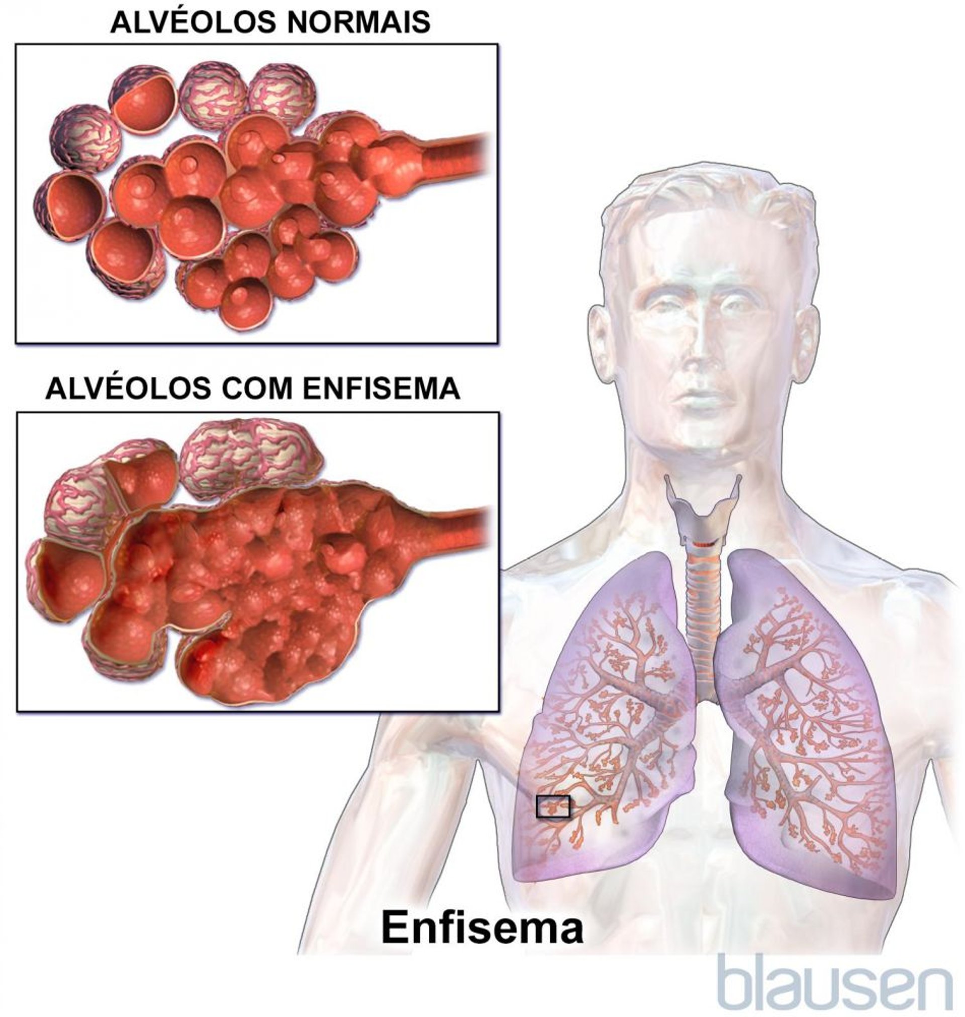 Enfisema