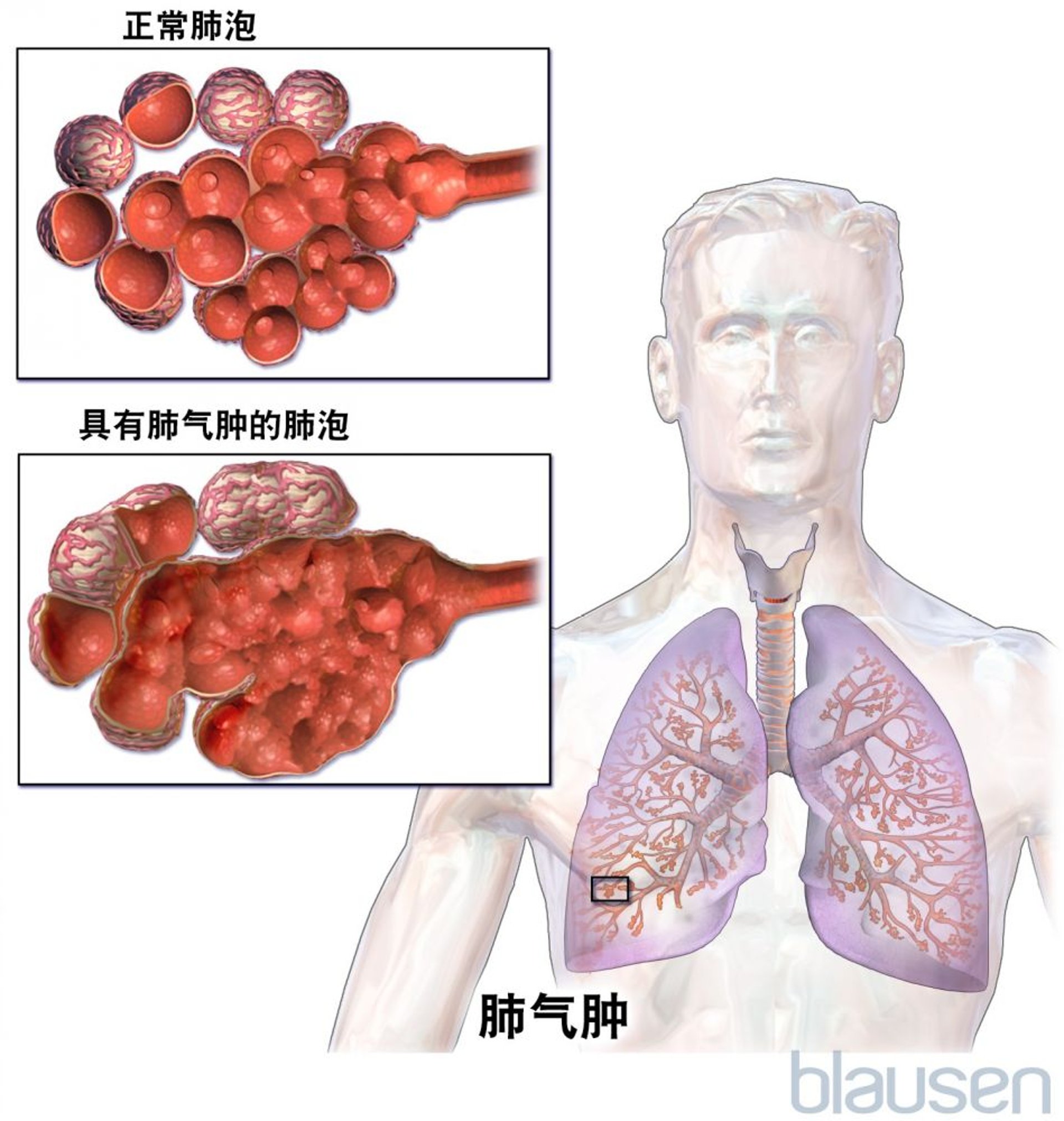 肺气肿