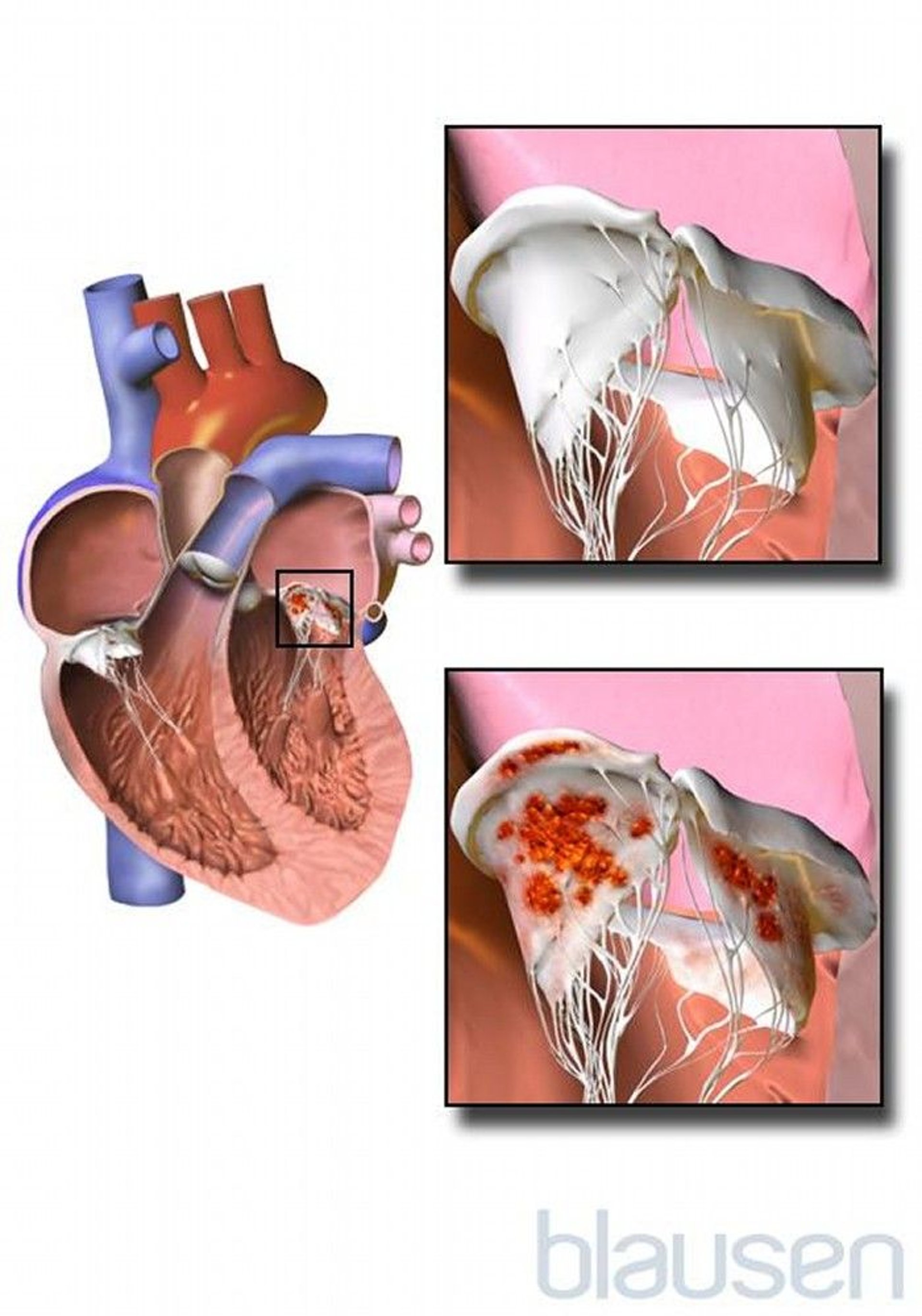 Endocarditis