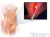 Ablação endometrial