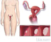 Endometrial Cancer