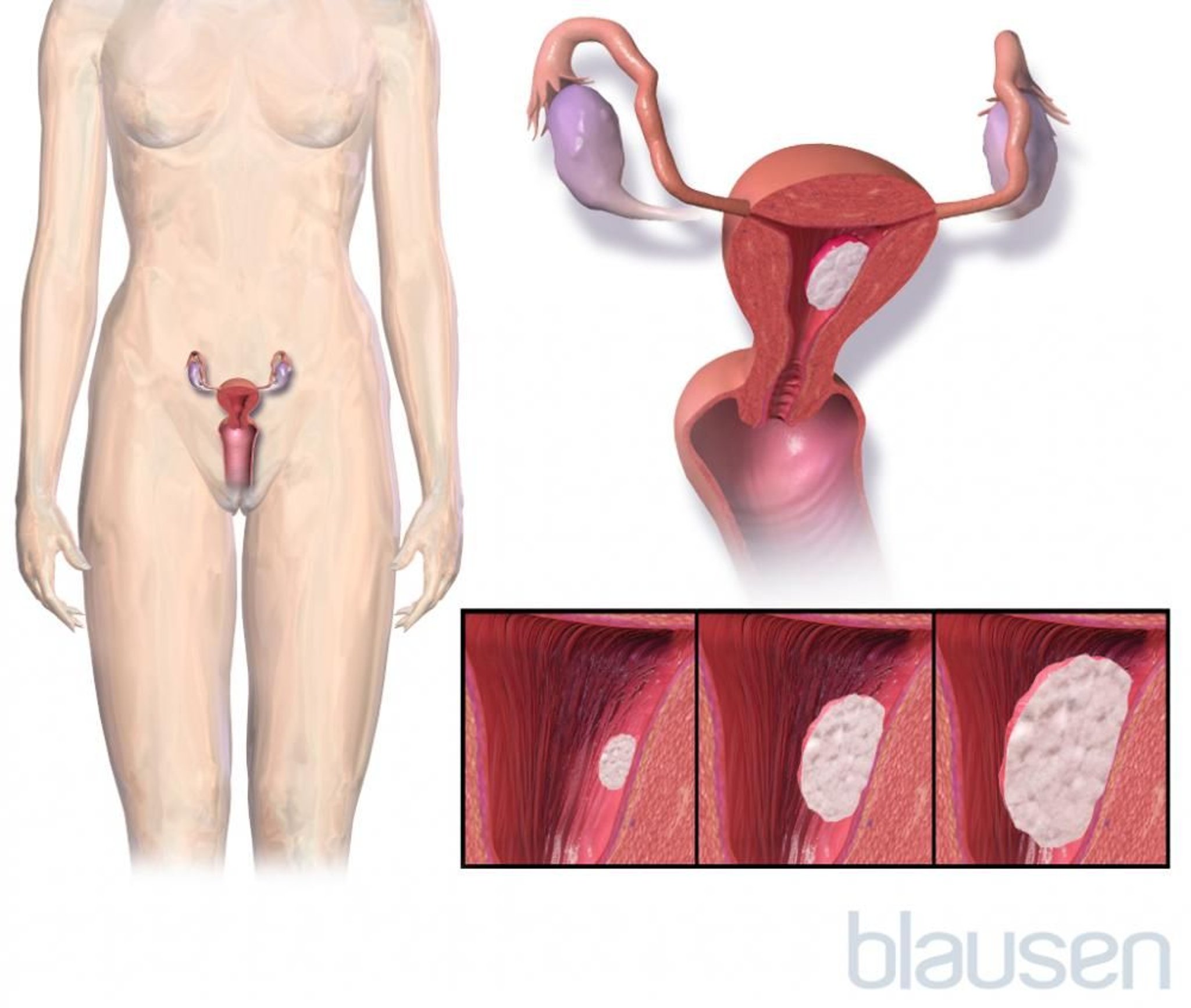 Endometriumkarzinom (Krebserkrankung der Gebärmutterschleimhaut)