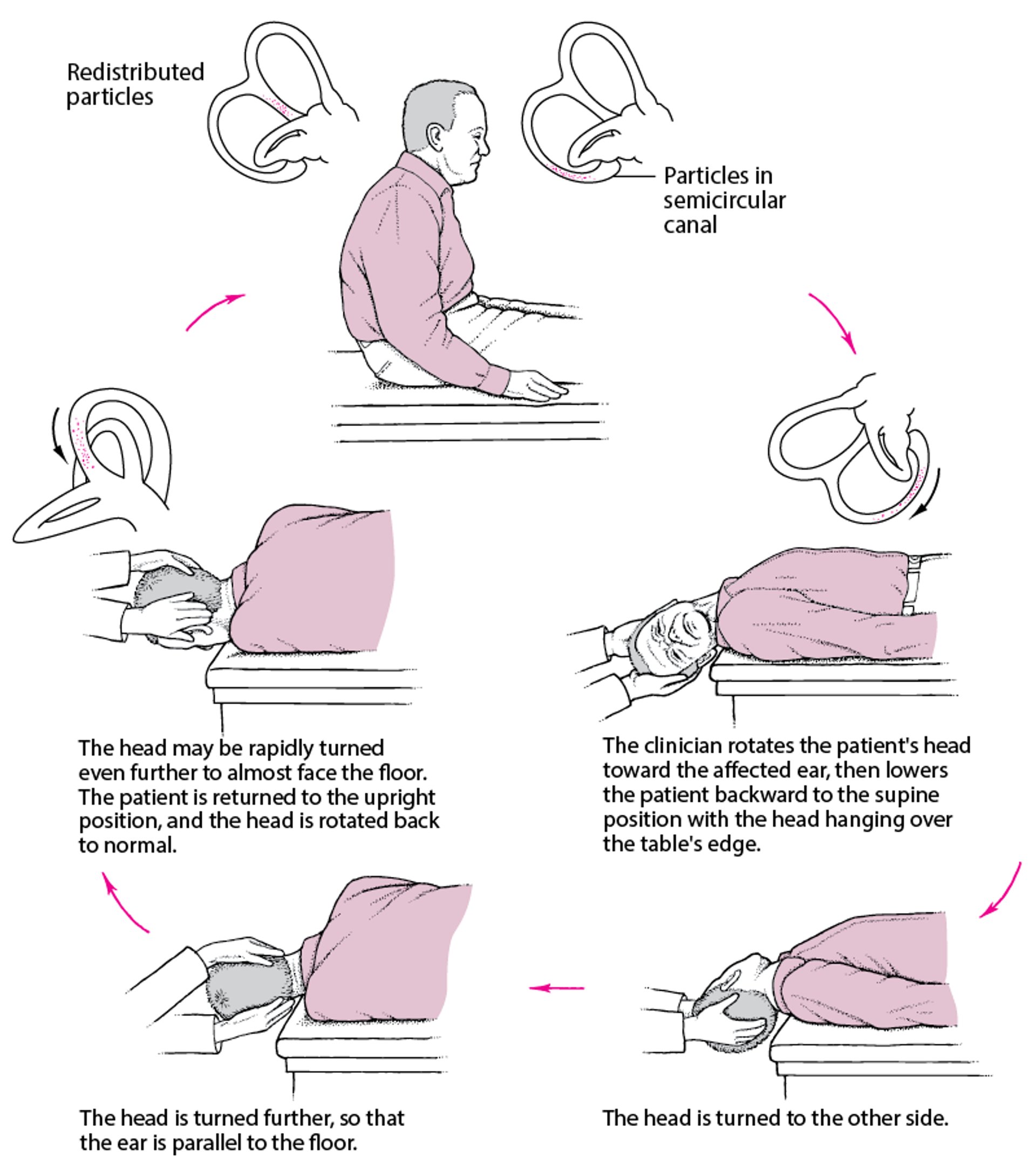 Epley Maneuver: A Simple Treatment for a Common Cause of Vertigo