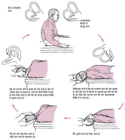 इप्ले मैन्युवर: वर्टिगो के एक आम कारण के लिए एक सरल उपचार