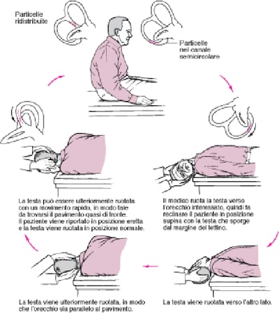 Manovra di Epley: un trattamento semplice per una causa comune di vertigini