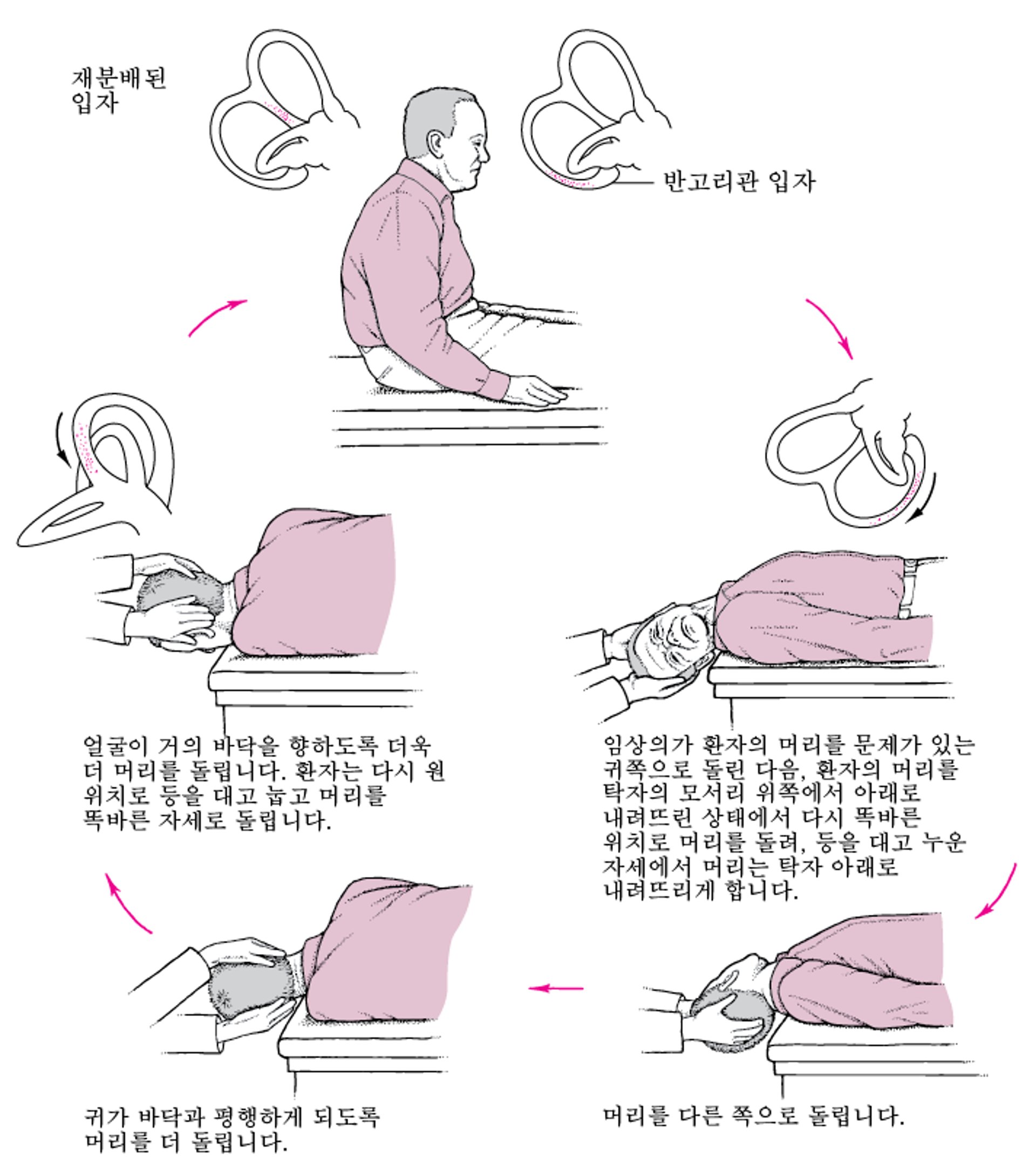 위치교정술: 현기증의 일반적인 원인을 위한 간단한 치료법