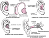 Audífonos: amplificación del sonido