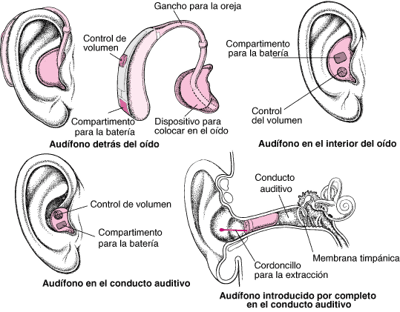 Audífonos: amplificación del sonido