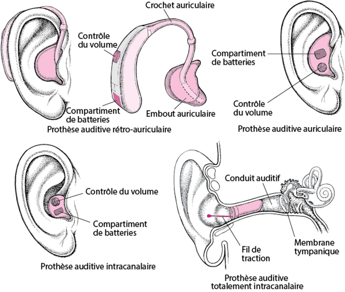 Appareils auditifs : Amplifiant le son