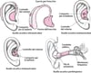 Apparecchi acustici: amplificazione del suono