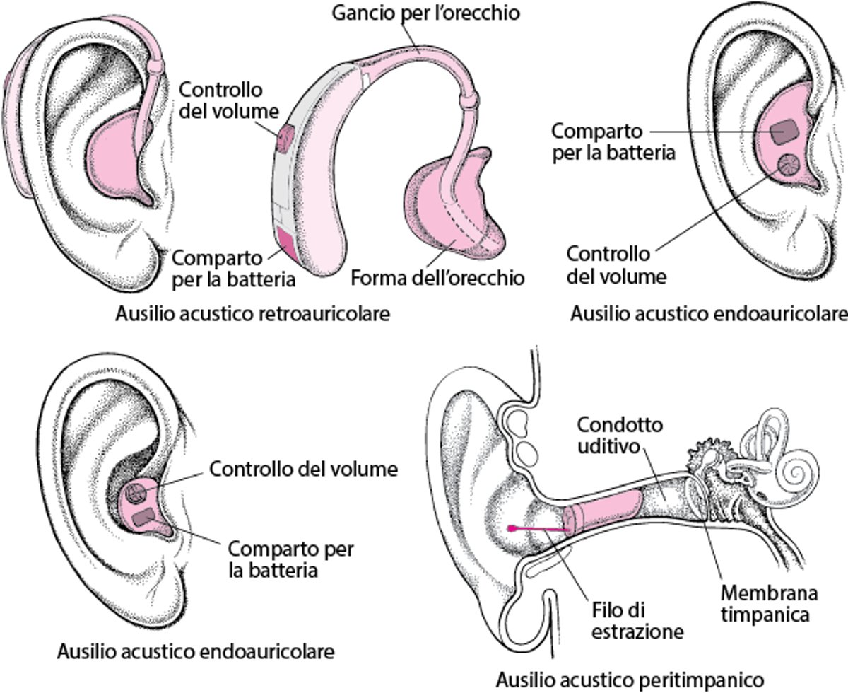 Apparecchi acustici: amplificazione del suono