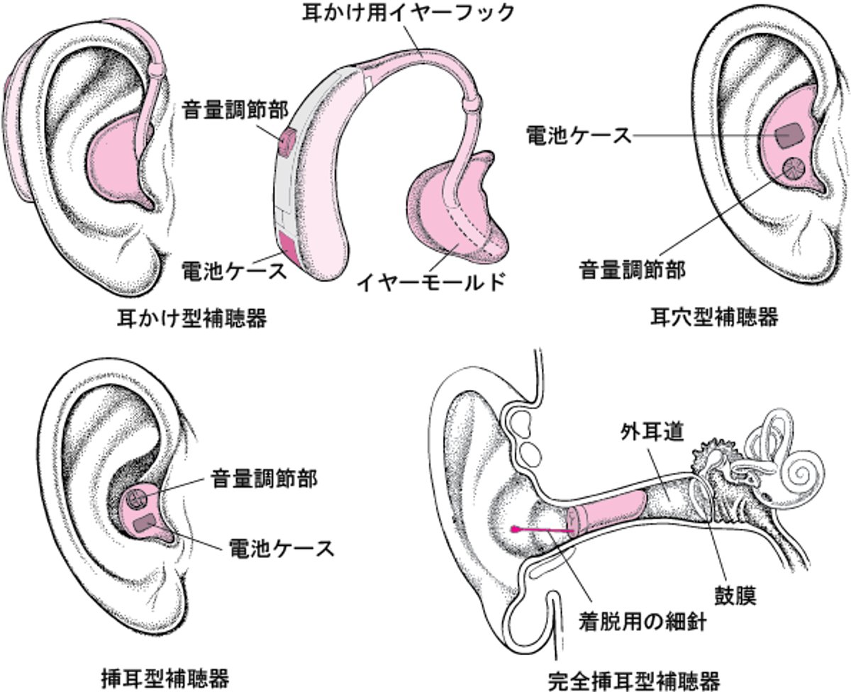 補聴器：音を増幅する装置