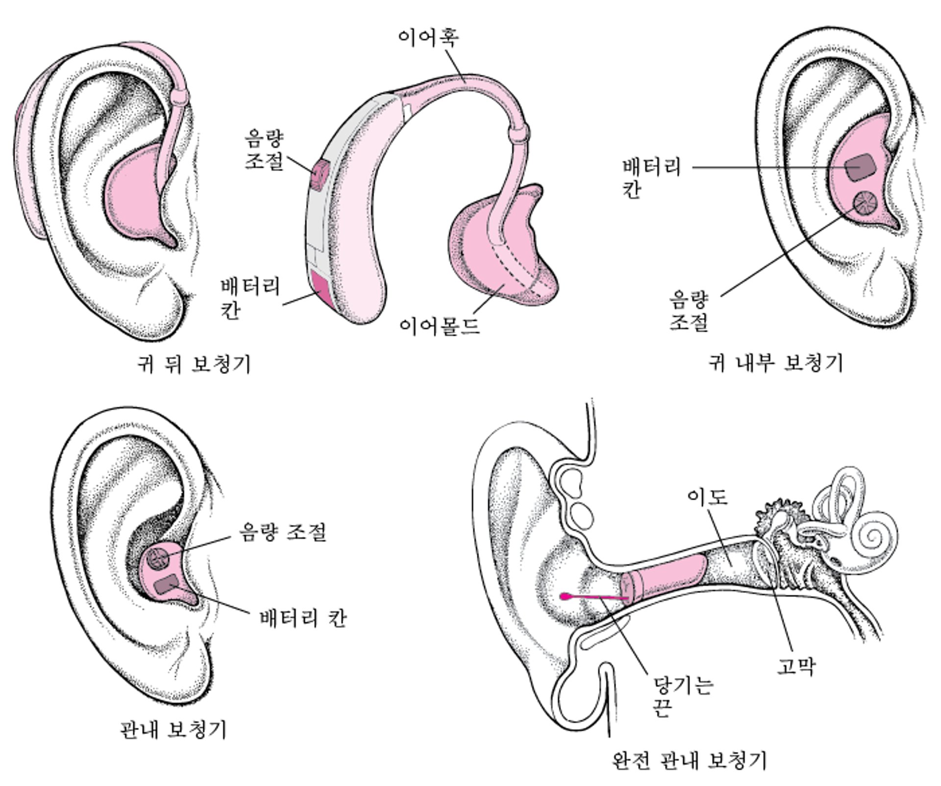 보청기: 음성의 증폭