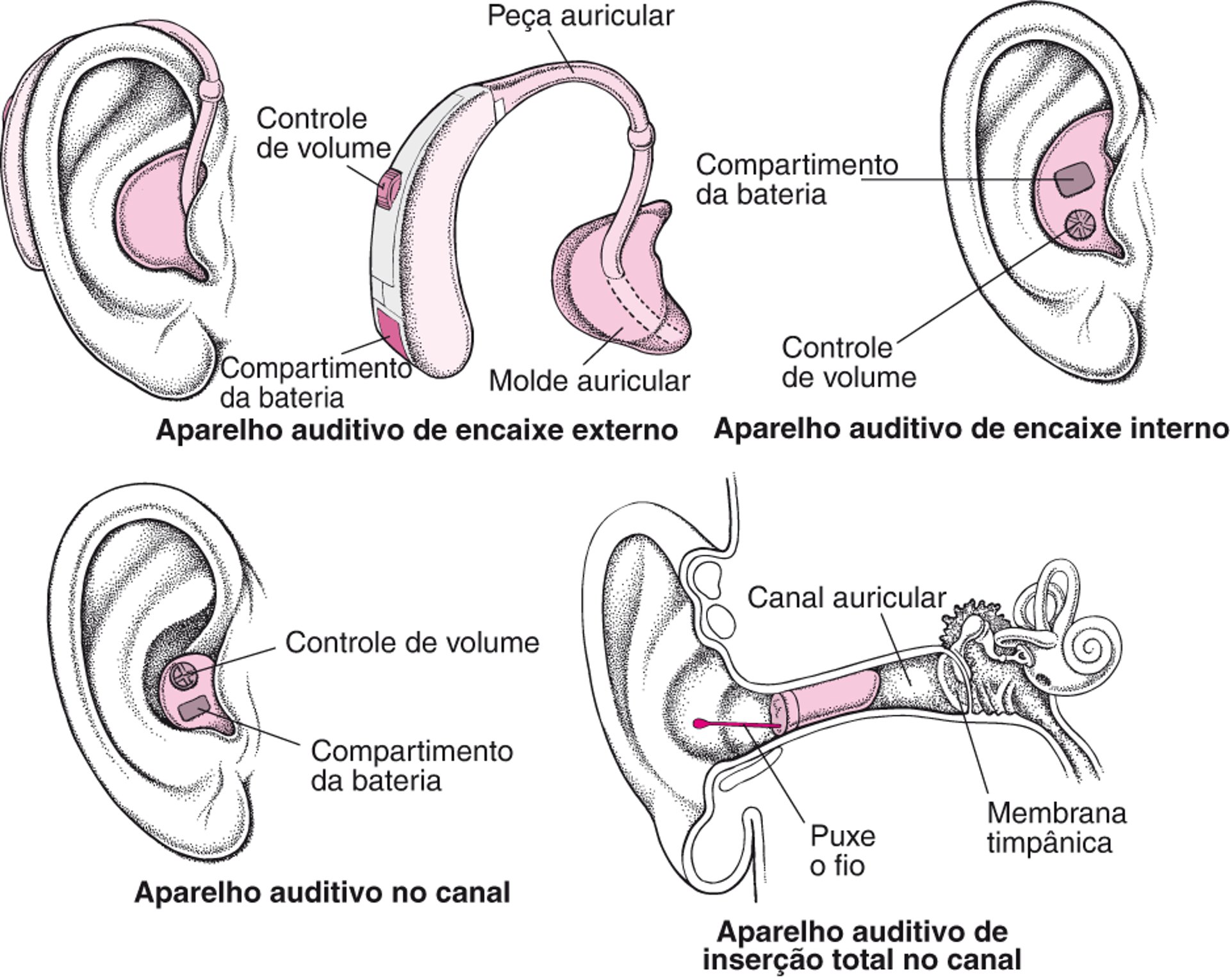 Aparelhos auditivos: Amplificando o som