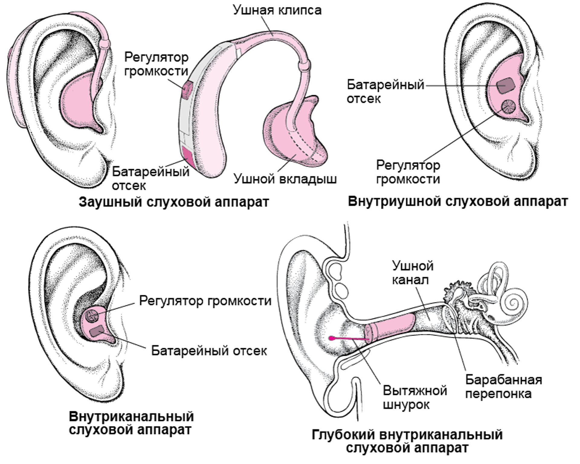 Слуховые аппараты: усиление звука