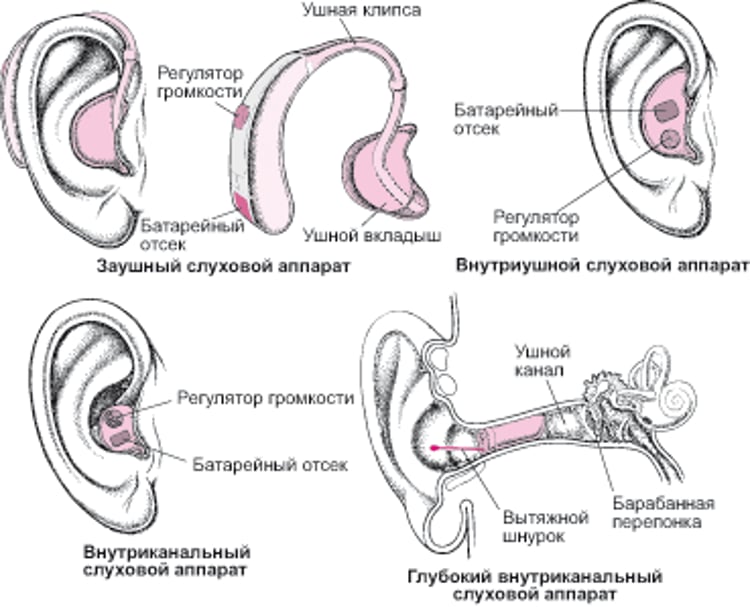 Слуховые аппараты: усиление звука