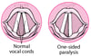 Vocal Cord Paralysis