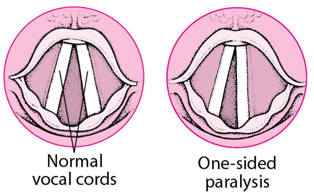 Vocal Cord Paralysis